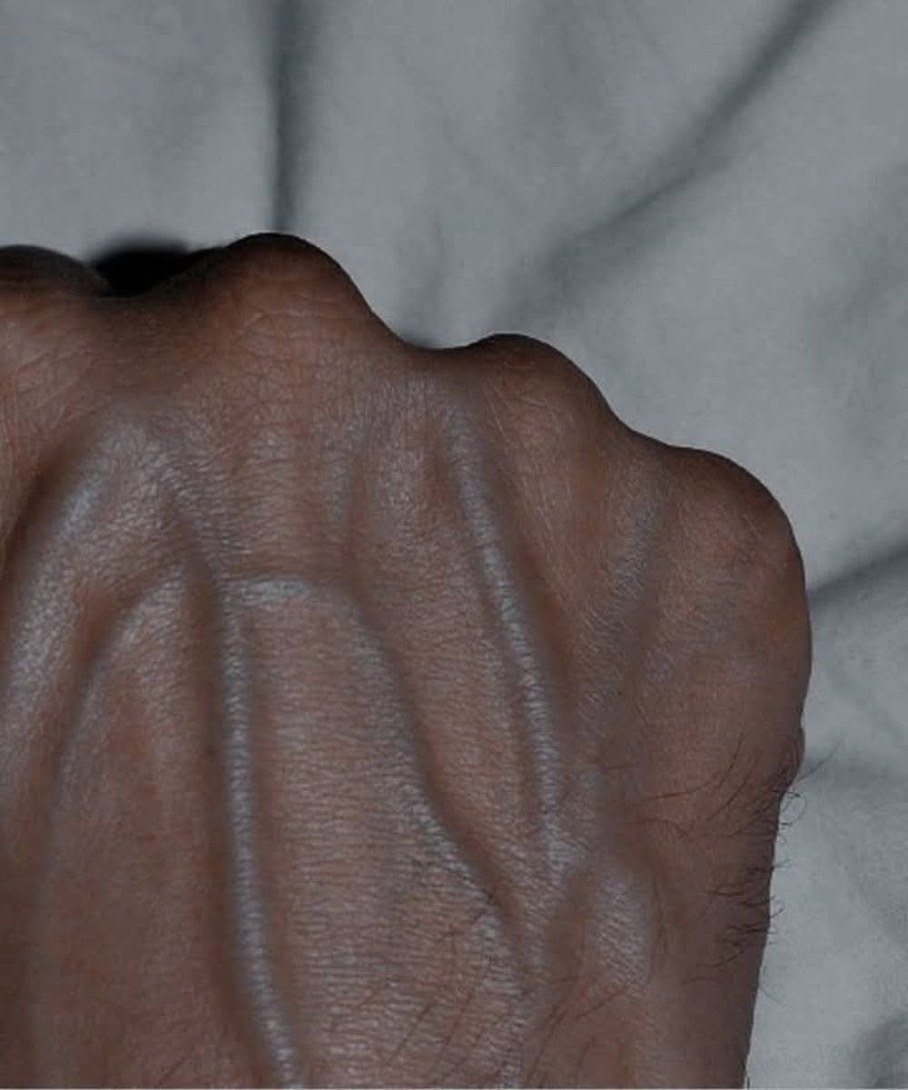If the veins on your arm are visibly prominent, this is :A: signal that