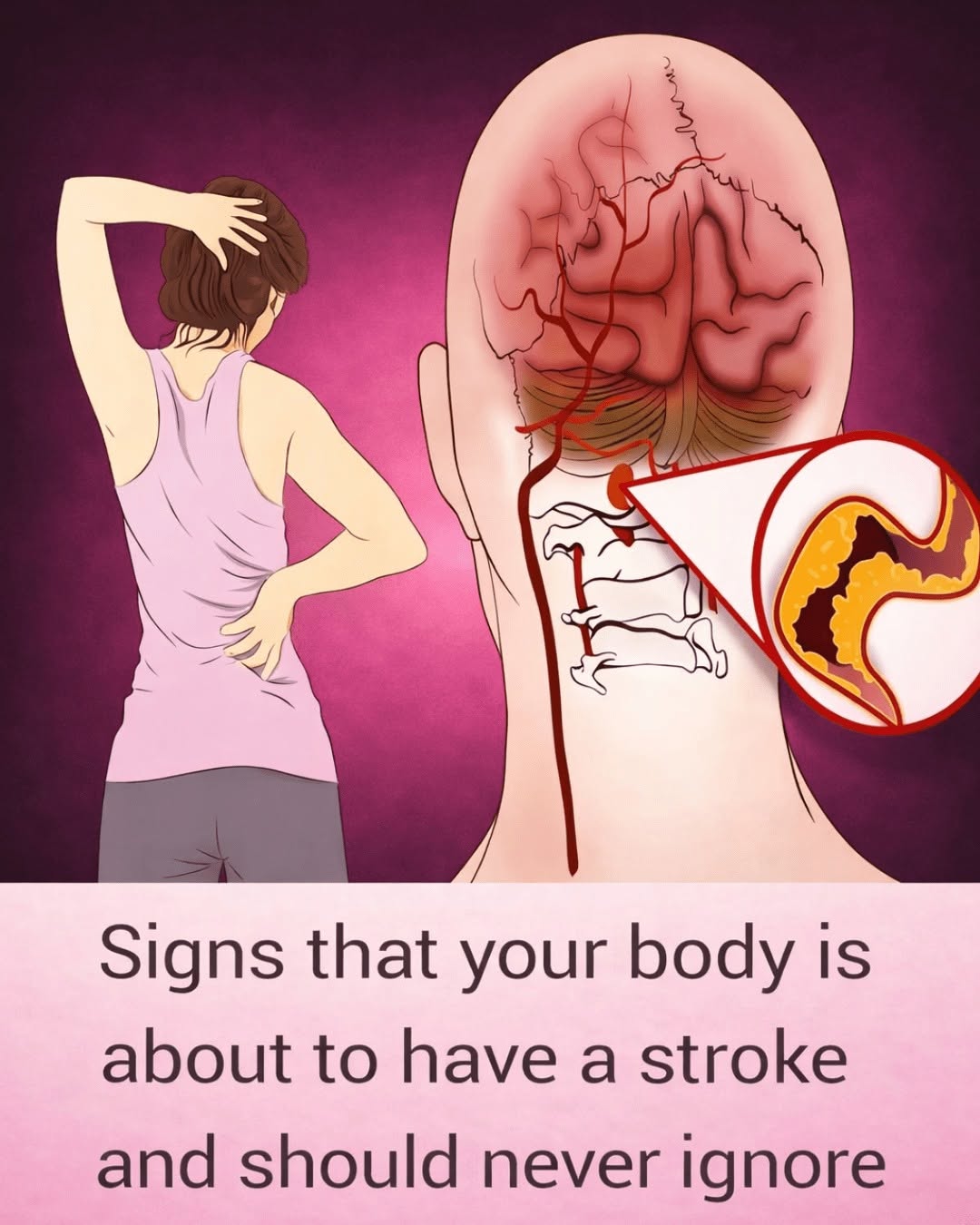 10 Early Warning Signs of a Stroke Everyone Should Know to Take Prompt Action