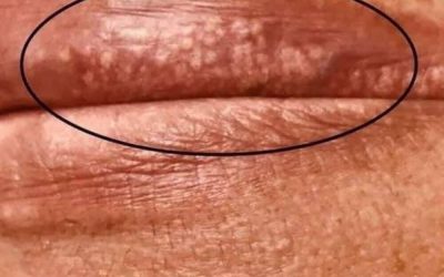 If you are getting these pimples on your lips or int;im:ate area, it is because…