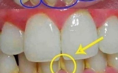 Remove dental plaque in 5 minutes naturally, without going to the dentist.