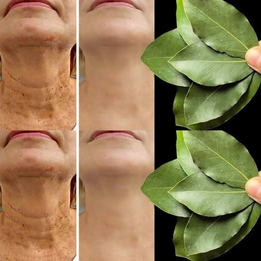 Bay Leaf Is 100,000 Times Stronger Than Botox? | Natural Wrinkle Eraser Even at Age 70!