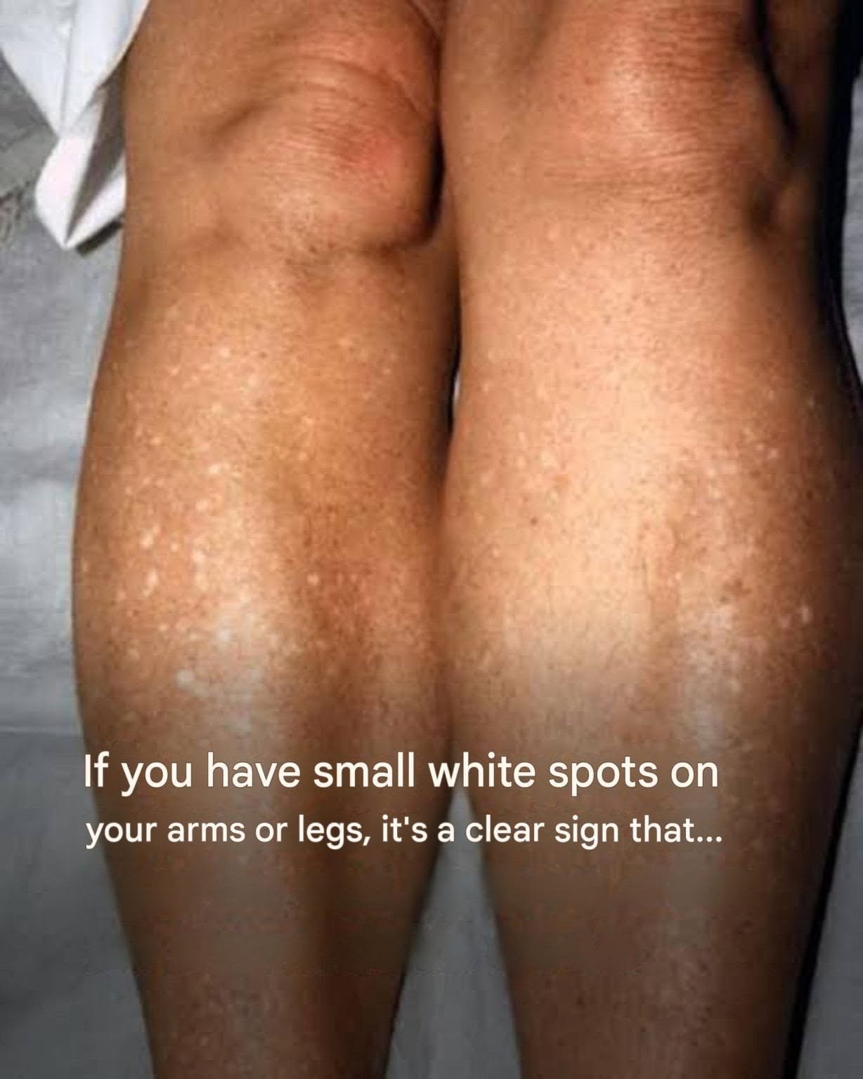 If you have small white spots on your arms or legs, it’s a clear sign that…See more