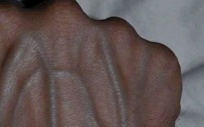 Visible Veins Explained: Normal Causes, Health Risks, and When to Worry